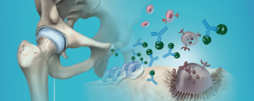 Jak na celoživotní léčbu osteoporózy?